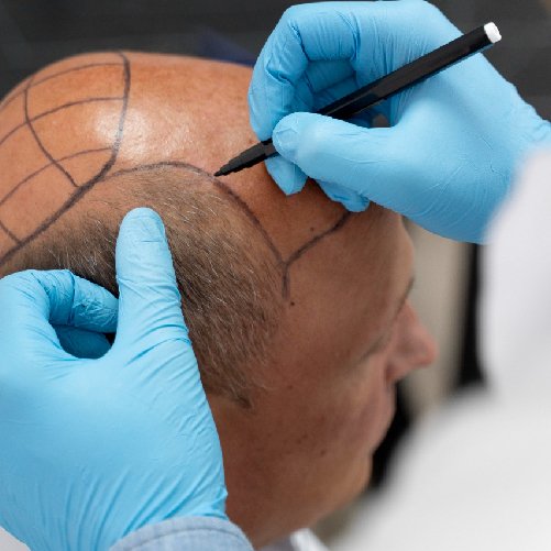 Follicular Unit Extraction